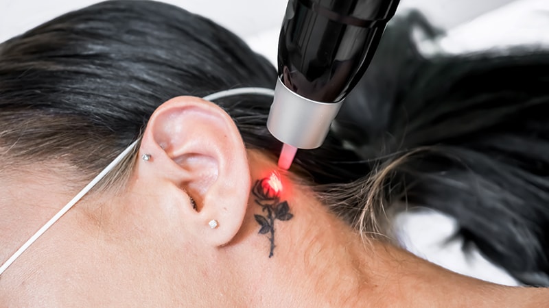 Laser Tattoo Removal Cancer Risk: All the Facts You’ll Ever Need to Know