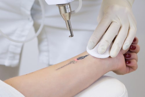 Laser Tattoo Removal Cancer Risk: All the Facts You’ll Ever Need to Know