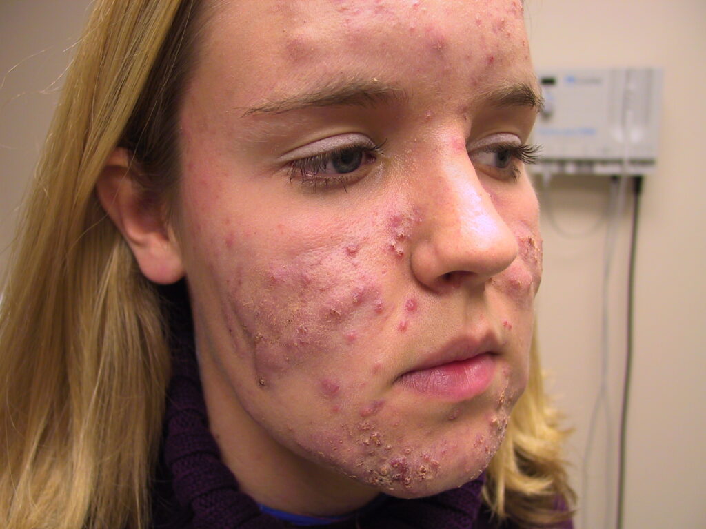 Acne Problems